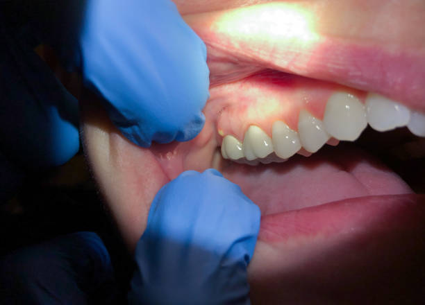 Best Broken Tooth Emergency  in Wintersville, OH